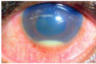 A 29-year-old man comes to the office with right eye pain, redness, and blurry vision for the past 2 days.  Physical examination findings are shown below.  No discharge is present.   Which of the following is the most likely diagnosis? A) Acute angle-closure glaucoma B) Anterior uveitis C) Bacterial conjunctivitis D) Episcleritis E) Hordeolum