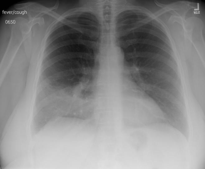 A 54-year-old woman comes to the emergency department due to persistent nonproductive cough, mild shortness of breath, and sharp, right-sided chest pain over the last week.  The patient has been taking moxifloxacin prescribed by her primary care physician for the last 5 days, but her symptoms have not improved.  She was diagnosed with early-stage right breast cancer 5 months ago and underwent lumpectomy and radiation therapy, which she completed 6 weeks ago.  Her other medical issues include hypertension, hyperlipidemia, and gastroesophageal reflux disease.  The patient has had no prior respiratory problems and is a lifelong nonsmoker. Temperature is 38.4 C (101.1 F) , blood pressure is 150/90 mm Hg, pulse is 80/min, and respirations are 15/min.  Examination reveals crackles over the right lower lung with dullness on percussion.  The remainder of the examination is unremarkable. Laboratory studies reveal a leukocyte count of 13,000/mm<sup>3</sup>.  Chest x-ray is shown below.   Previous chest x-ray performed at the time of the patient's breast cancer diagnosis was unremarkable, and echocardiography revealed a normal left ventricular ejection fraction, evidence of diastolic dysfunction, and no significant valvular abnormalities. This patient would most likely respond to which of the following therapies? A) Doxycycline B) Furosemide C) Prednisone D) Trimethoprim-sulfamethoxazole E) Voriconazole