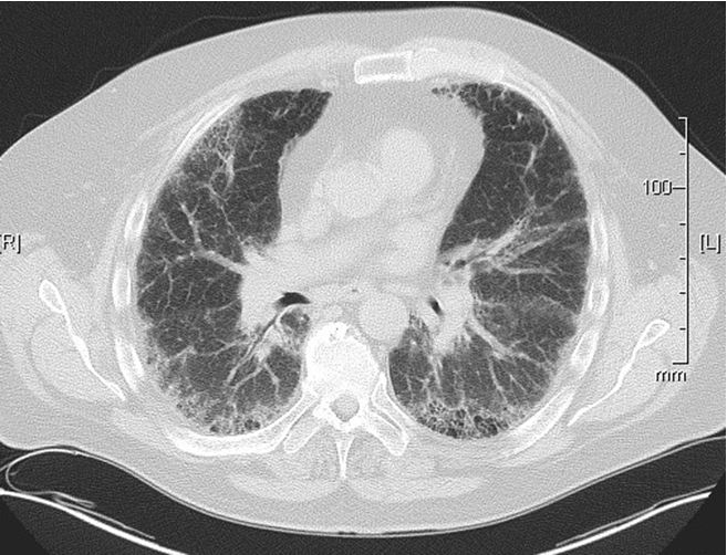 A 65-year-old man is evaluated for progressively worsening dyspnea for the past year.  His past medical history is significant for hypertension and acid reflux disease.  Six months ago, he complained of a dry cough.  At that visit, his omeprazole dose was increased from 20 mg daily to 20 mg twice daily, and his blood pressure medication was switched from lisinopril to amlodipine.  These interventions did not help, however, and his symptoms continued to worsen.  He is a lifelong nonsmoker and retired after working as a chemical engineer at an oil refinery for 35 years. His temperature is 37.2 C (99 F) , blood pressure is 120/80 mm Hg, pulse is 78/min, and respirations are 16/min.  His pulse oximetry at rest is 94% on room air and decreases to 82% after walking for 3 minutes.  He has finger clubbing.  There is no jugular venous distension.  Heart sounds are normal without murmurs.  Lung auscultation shows diffuse, dry, mid-inspiratory crackles bilaterally.  There is no swelling or tenderness of any joints, including the proximal interphalangeal and metacarpophalangeal joints of the hands. Laboratory results are as follows:   High-resolution chest CT scan is performed; a representative image is shown below.   Which of the following is the most likely diagnosis in this patient? A) Bronchiectasis B) Cryptogenic organizing pneumonia C) Idiopathic pulmonary fibrosis D) Rheumatoid lung disease E) Sarcoidosis