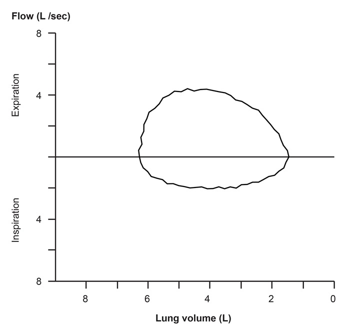 A 64-year-old woman comes to the office due to worsening dyspnea on exertion and a  whistling noise  while breathing heavily during exercise.  These symptoms have worsened over the past 3 months.  The patient has had no cough, fever, hoarseness, or weight change.  She has hypertension and hyperlipidemia and had a coronary artery bypass graft 4 years ago.  Physical examination reveals no cardiopulmonary abnormality.  A flow-volume loop demonstrates the following:   What is the most likely etiology of this patient's symptoms? A) Adult-onset asthma B) Emphysema C) Obstructive substernal goiter D) Tracheomalacia E) Unilateral vocal cord paralysis