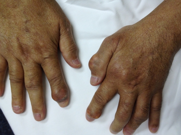 A 65-year-old man comes to the physician due to attacks of joint pain and swelling that affect primarily his hands but sometimes his knees or elbows.  He currently has no pain, but the episodes occur once or twice a month. The patient's other medical problems include type 2 diabetes mellitus and hypertension.  He has not seen a physician for 2 years, and he has managed his diabetes with diet.  He was diagnosed with arthritis 2 years ago at a different clinic and was prescribed ibuprofen.  The patient smokes 1-2 packs of cigarettes a day and drinks 2-3 cans of beer each night. Temperature is 36.7 C (98 F) , blood pressure is 155/96 mm Hg, pulse is 84/min, and respirations are 16/min.  The patient's BMI is 35 kg/m<sup>2</sup>.  He has clear lungs and normal first and second heart sounds.  His abdomen is obese, nontender, and without hepatosplenomegaly.  His fingers are shown in the images below.  There is no joint tenderness and no joint effusions are present elsewhere.       Serum creatinine level is normal and fasting blood glucose level is 133 mg/dL. Which of the following agents is most likely to provide long-term relief for this patient's symptoms? A) Allopurinol B) Etanercept C) Methotrexate D) Prednisone E) Sulfasalazine
