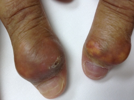 A 65-year-old man comes to the physician due to attacks of joint pain and swelling that affect primarily his hands but sometimes his knees or elbows.  He currently has no pain, but the episodes occur once or twice a month. The patient's other medical problems include type 2 diabetes mellitus and hypertension.  He has not seen a physician for 2 years, and he has managed his diabetes with diet.  He was diagnosed with arthritis 2 years ago at a different clinic and was prescribed ibuprofen.  The patient smokes 1-2 packs of cigarettes a day and drinks 2-3 cans of beer each night. Temperature is 36.7 C (98 F) , blood pressure is 155/96 mm Hg, pulse is 84/min, and respirations are 16/min.  The patient's BMI is 35 kg/m<sup>2</sup>.  He has clear lungs and normal first and second heart sounds.  His abdomen is obese, nontender, and without hepatosplenomegaly.  His fingers are shown in the images below.  There is no joint tenderness and no joint effusions are present elsewhere.       Serum creatinine level is normal and fasting blood glucose level is 133 mg/dL. Which of the following agents is most likely to provide long-term relief for this patient's symptoms? A) Allopurinol B) Etanercept C) Methotrexate D) Prednisone E) Sulfasalazine
