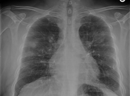 A 35-year-old immigrant from Eastern Europe comes to the office due to dry cough, malaise, and fatigue.  He has had joint aches and involuntary weight loss over the past 3 months.  His other medical problems include severe allergies that manifest as nasal stuffiness, headache, and ear pain.  He takes over-the-counter decongestants.  He is a construction worker, smokes a pack of cigarettes a day, and drinks 6 cans of beer once a week.  His mother suffers from severe rheumatoid arthritis. His temperature is 37.2 C (99 F) , blood pressure is 122/70 mm Hg, and pulse is 89/min.  He has tenderness on palpation of bilateral maxillary sinuses.  Tympanic membranes are full and bulging bilaterally.  Pulmonary auscultation reveals occasional rhonchi.  There are no heart murmurs.  The tip of the spleen is not palpable.  There are no skin rashes or joint swelling. Laboratory results are as follows:   Liver panel is unremarkable.  Urinalysis is positive for blood and protein, and urine sediment analysis reveals multiple red blood cells casts.  Chest x-ray is shown below.   Which of the following is most likely to establish this patient's diagnosis? A) Anti-double-stranded DNA antibodies B) Anti-myeloperoxidase antibodies C) Anti-proteinase 3 antibodies D) Bone marrow biopsy E) Tuberculin skin testing