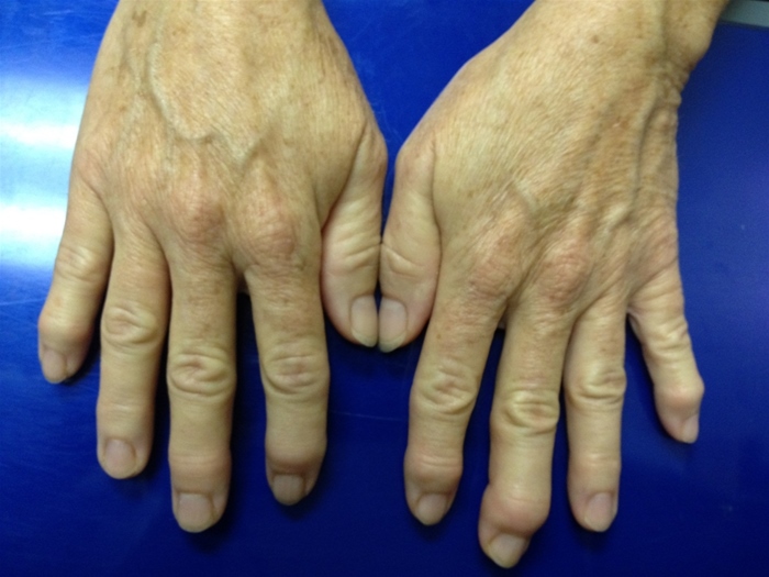 A 53-year-old seamstress comes to the physician with pain and intermittent swelling in her fingers for the past 3 years.  Symptoms involve primarily the distal interphalangeal joints and occur after she sews.  A year ago, she was hospitalized with upper gastrointestinal bleeding and was found to have erosive gastritis and a duodenal ulcer.  Her other medical problems include hypertension, type 2 diabetes mellitus, and fatty liver.  Her current medications are glipizide, sitagliptin, lisinopril, and amlodipine. Her blood pressure is 133/70 mm Hg and pulse is 78/min.  Her BMI is 26 kg/m<sup>2</sup>.  Her hands appear as shown below.  There is bony swelling and tenderness of several distal interphalangeal joints.  The remainder of the examination is within normal limits.   Laboratory results are as follows:   Liver function tests are within normal limits. Which of the following is the most appropriate treatment for this patient? A) Acetaminophen B) Adalimumab C) Celecoxib D) Methotrexate E) Naproxen