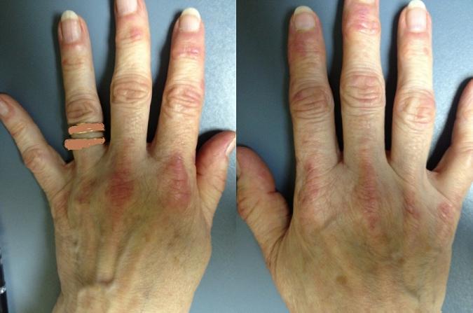 A 54-year-old woman comes to the physician with complaints of weakness and skin rash.  She thinks that her symptoms could be related to medications she started on over the last 6 months.  She was diagnosed with hypertension and hyperlipidemia and takes valsartan, amlodipine, chlorthalidone, and atorvastatin.  It has become progressively more difficult for her to perform activities of daily living.  She has no family history of skin disease. Her vital signs are normal.  BMI is 33 kg/m<sup>2</sup>.  Physical examination findings are shown in the pictures below.  She has decreased muscle strength (4/5)  in the quadriceps muscles bilaterally.  Deep-tendon reflexes are 1+ and symmetrical.  The remainder of the physical examination is within normal limits.   Laboratory results are as follows:   Which of the following is the most likely diagnosis? A) Dermatomyositis B) Medication toxicity C) Psoriasis D) Systemic lupus erythematosus E) Systemic sclerosis