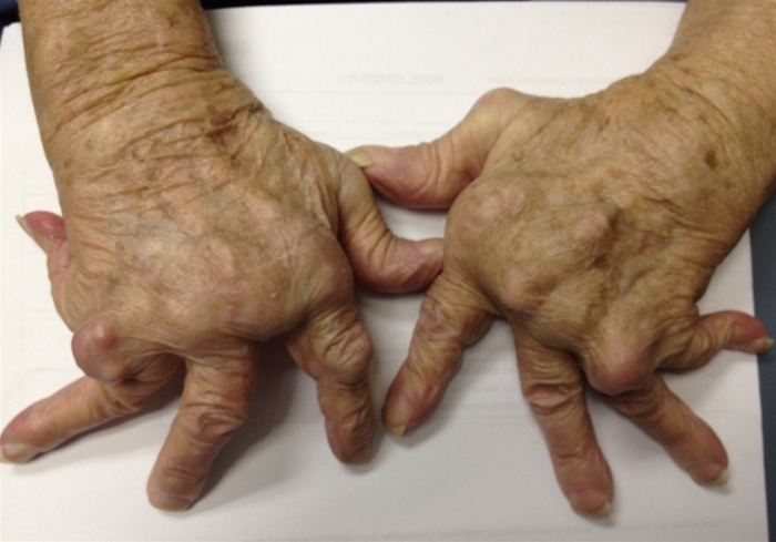 A 65-year-old woman with a history of rheumatoid arthritis comes to the physician with persistent hand pain aggravated by use.  She was prescribed tramadol and occupational therapy 1 year ago and has had no relief.  Rheumatoid arthritis was diagnosed 20 years ago, and she was started on methotrexate, prednisone, and hydroxychloroquine at that time.  She was prescribed etanercept 10 years ago and switched to adalimumab 5 years later due to persistent disease activity.  The patient's other medical problems include hypertension and acid reflux disease.  Her current medications include methotrexate, hydroxychloroquine, adalimumab, tramadol, prednisone, and ibuprofen.  She does not use tobacco, alcohol, or illicit drugs. Her vital signs are normal.  Musculoskeletal examination is notable for the presence of rheumatoid deformities in the hands (shown below)  and feet.  There is no joint tenderness or effusion.  Neurological examination is within normal limits.   Laboratory results are as follows:   Which of the following is the most appropriate next step in management? A) Add infliximab to the current regimen B) Add sulfasalazine to the current regimen C) Prescribe a short course of high-dose prednisone D) Refer for orthopedic evaluation E) Switch from oral to subcutaneous methotrexate