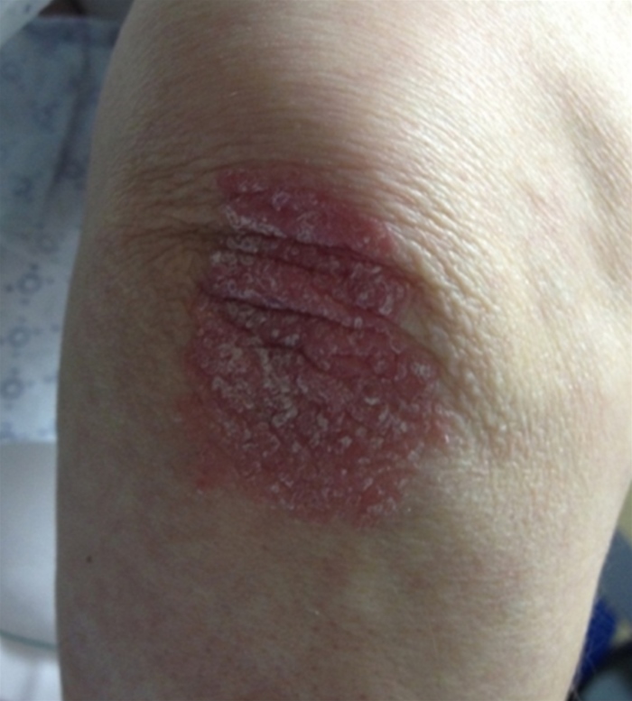 A 45-year-old woman is evaluated in the jail clinic for pain and swelling of her right knee.  The pain started 2 weeks ago without any associated trauma.  She has no fever, dysuria, vaginal discharge, or history of arthritis.  She has had fatigue, poor appetite, and an unintentional weight loss of 9 kg (20 lb)  over the past 6 months.  Several scaly and erythematous skin lesions have also appeared during this time.  She takes ibuprofen as needed.  She has a 30-pack-year history of smoking, used to drink occasionally, and does not use illicit drugs.  She has been in jail for 3 years. Her vitals signs are normal.  She has several white-to-yellowish flaky scales on the scalp and in the nasolabial folds.  No scleral injection or oral ulcers are noted.  The right knee joint has moderate-size effusion.  The second toe of the left foot appears swollen with slight bluish discoloration and is slightly tender.  There is a lesion on the left knee (shown below)  and similar lesions on the extensor aspect of the elbows, chest, and upper back.  The remainder of the physical examination is within normal limits.   The right knee is aspirated, and synovial fluid analysis is as follows:   Which of the following is most likely worsening this patient's illness? A) Hepatitis B virus B) Hepatitis C virus C) Human immunodeficiency virus D) Neisseria gonorrhoeae E) Mycobacterium tuberculosis