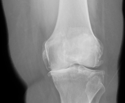 A 55-year-old woman comes to the physician with worsening left knee pain.  She has had intermittent pain and stiffness in her left knee for the past 5 years.  The pain is aggravated by prolonged standing, but her knee also feels stiff if she sits in 1 place for too long.  She was diagnosed with ulcerative colitis 3 years ago.  The patient initially was treated with systemic steroids, and the disease is currently in remission on oral sulfasalazine.  Her other medical problems include hypertension, impaired glucose tolerance, and hypothyroidism. The patient's vital signs are normal.  Her BMI is 31 kg/m<sup>2</sup>.  On physical examination, flexion and extension of the left knee joint elicit pain, but there is no instability.  There is a small joint effusion.  Knee joint aspiration yields 3 mL of synovial fluid.  Synovial fluid analysis shows a total cell count of 2000/µL with 25% polymorphonuclear cells. An x-ray of the left knee is shown below.   Which of the following is the most likely diagnosis? A) Arthritis associated with inflammatory bowel disease B) Avascular necrosis of femur C) Calcium pyrophosphate crystal deposition disease D) Osteoarthritis E) Patellofemoral pain syndrome
