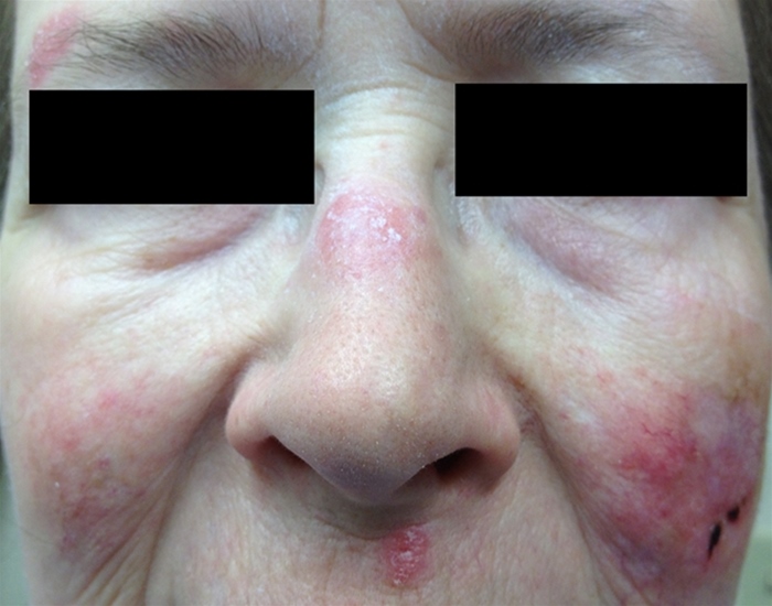 A 55-year-old woman comes to the physician with a rash on her face for the past 4 weeks.  The rash seems to get worse when she spends time outdoors, but it does not flare with food intake.  She has no flushing or itching.  The patient denies fever, weight loss, or muscle weakness.  She was recently diagnosed with hypertension and type 2 diabetes mellitus and started on lisinopril, metformin, and sitagliptin. Physical examination reveals a 1-cm ulcer in the roof of the hard palate.  A photograph of the rash is shown below.   Which of the following conditions is the most likely diagnosis? A) Erythema multiforme B) Erythematotelangiectatic rosacea C) Fixed drug eruption D) Seborrheic dermatitis E) Systemic lupus erythematosus
