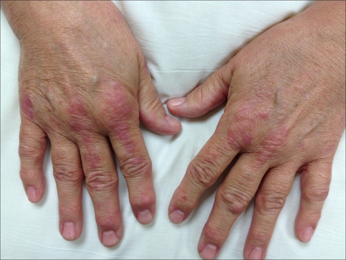 A 65-year-old woman comes to the physician with a rash on her hands for the past 2 weeks.  Two months ago she developed a rash on her face and forearms while vacationing at a beach resort.  Her review of systems is positive for recent onset weakness of the shoulders and hips.  She has no dysphagia, shortness of breath, fever, chills, or weight loss.  She is a lifetime nonsmoker. Her temperature is 37.2 C (99 F) , blood pressure is 134/82 mm Hg, pulse is 75/min, and respirations are 14/min.  Her BMI is 21 kg/m<sup>2</sup>.  Cardiopulmonary examination is within normal limits.  There is no hepatosplenomegaly.  Range of motion of the spine is normal and without pain, scoliosis, or excessive kyphosis of the back.  Upper and lower limb deep-tendon reflexes are 2+.  She has difficulty rising from a chair.  Muscle strength is 4/5 in both upper and lower extremities. Laboratory results are as follows:   The rash is shown in the photograph.   This patient would require which of the following? A) Anti dsDNA antibodies testing B) Cancer screening C) Dilated funduscopic examination D) Liver biopsy E) Trial of low-dose prednisone