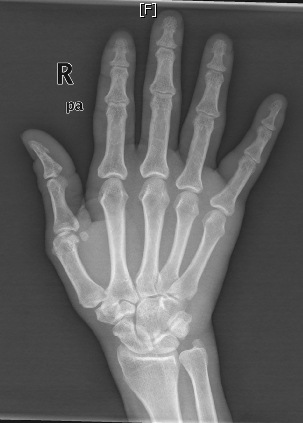 A 32-year-old right-hand-dominant woman living in New Hampshire comes to the physician complaining of right wrist pain for the past 3 months.  She has no history of tick bites, recent travel, or illness in the family.  Review of systems is negative for fever, pain or swelling in any other joints, skin rash, or recent gastrointestinal or genitourinary infections.  The patient is sexually active in a monogamous relationship.  She delivered her first child 4 months ago.  She smokes marijuana occasionally. Her temperature is 37.2° C (99° F) , blood pressure is 110/78 mm Hg, pulse is 78/min, and respirations are 12/min.  She weighs 80 kg (176 lb) .  There is a sharp tenderness on palpation of the radial styloid at the wrist.  The pain is aggravated on ulnar deviation of the wrist after she is asked to make a fist over the thumb.  There is no synovitis or tenderness noted on any other joints.  The right hand x-ray is shown below.   Which of the following is the most likely diagnosis? A) Carpal tunnel syndrome B) de Quervain's tenosynovitis C) Gonorrheal arthritis D) Lyme arthritis E) Osteoarthritis of the first carpometacarpal joint