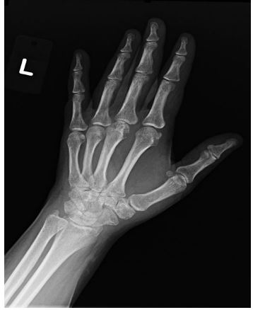 A 38-year-old woman is evaluated for joint pain and fatigue, which has been slowly progressive over the last year.  Her other past medical problems include migraine headaches, lower back pain, and non-ulcer dyspepsia.  She has had no miscarriages or thrombotic events. Vital signs are within normal limits.  Her body mass index is 30 kg/m<sup>2</sup>.  Examination shows symmetric tenderness of multiple small joints in the hands and a small effusion at the left knee. X-ray image of the left hand is shown below.   Which of the following would have the most prognostic value for this patient? A) Anti-cyclic citrullinated peptide antibodies B) Antinuclear antibody profile C) Anti-tissue transglutaminase antibodies D) Number of fibromyalgia tender points E) Fasting transferrin saturation
