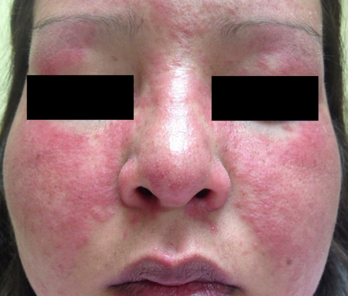 A 35-year-old woman comes to the physician for a follow-up visit.  She was recently diagnosed with systemic lupus erythematosus after a 2-month history of fatigue and a skin rash.  She was advised to use over-the-counter hydrocortisone cream for the facial rash but it did not help.  Her previous medical history is insignificant.  The patient has never been pregnant.  She does not use tobacco and drinks only 1 or 2 alcoholic beverages a week.  She currently takes no prescription medications. Her vital signs are normal.  Skin findings are shown in the image below.   Which of the following is the best therapy for this patient's rash? A) Dapsone B) Hydroxychloroquine C) Isotretinoin D) Lenalidomide E) Methotrexate