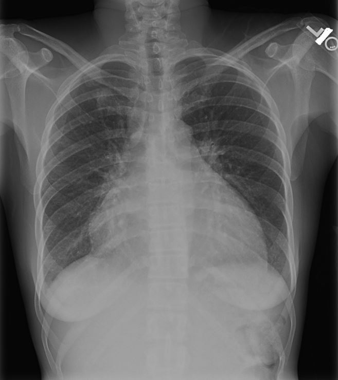 <strong>A 43-year-old woman complains of fatigue and shortness of breath over the last 2 weeks.&nbsp; She has no chest pain, nausea, vomiting, or weight loss.&nbsp; She reports a recent upper respiratory tract infection.&nbsp; The patient does not use tobacco, alcohol, or illicit drugs.&nbsp; Her blood pressure is 98/55 mm Hg and pulse is 105/min.&nbsp; Jugular veins are distended with the patient in the seated position.&nbsp; Lungs are clear to auscultation.&nbsp; Chest x-ray is shown below.   Which of the following is the most likely additional finding in this patient?</strong> A)Audible fourth heart sound B)Fixed splitting of the second heart sound C)Intermittent ptosis D)Nonpalpable point of maximal impulse E)Opening snap F)Pulsus bisferiens <div style=padding-top: 35px> 