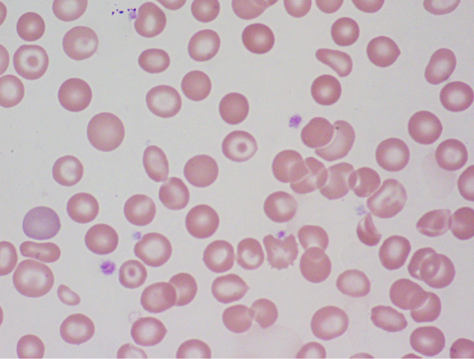 A 32-year-old Italian-American man comes to the office for a routine checkup.  The patient is a business executive and has been under significant stress recently.  He drinks alcohol occasionally and has a 10-pack-year smoking history.  Laboratory results are as follows:   Serial fecal occult blood tests are negative.  Peripheral blood smear is shown in the image below.   Which of the following is the best treatment for this patient? A) Cobalamin B) Deferoxamine C) Erythropoietin D) Folic acid E) Hydroxyurea F) Iron G) Prednisone H) Reassurance with no specific therapy required I) Splenectomy