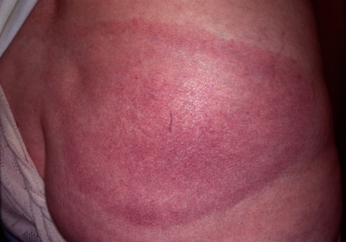 A 22-year-old woman, gravida 1 para 0, at 12 weeks gestation comes to the office due to 3 days  of rash, fever, and malaise.  The rash seems to be getting larger but does not hurt or itch.  Two weeks ago, the patient went camping in northern Massachusetts and had a tick bite while walking through the woods.  She has no known drug allergies.  Temperature is 38.3 C (101 F) , blood pressure is 110/80 mm Hg, pulse is 88/min, and respirations are 16/min.  The rash is shown in the image below.   The remainder of the examination is normal.  Which of the following is the most appropriate next step in the management of this patient? A) Amoxicillin B) Azithromycin C) Ceftriaxone D) Ciprofloxacin E) Observation