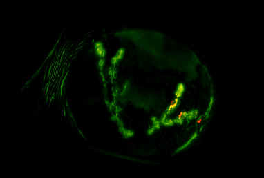 A 32-year-old man arrives at the emergency department with pain, watering, and redness in his left eye for the past 5 days.  He had similar symptoms in the same eye a few months ago that resolved after about a week.  The patient is a construction worker and has been remodeling the attic and roof of an older home for the past few weeks.  Temperature is 36.8 C (98.2 F) , blood pressure is 118/78 mm Hg, heart rate is 82/min.  Clear drainage is visible from the left eye, which is diffusely erythematous around the cornea.  The right eye and bilateral periorbital regions are unremarkable.  There are no oral lesions.  Slit-lamp examination of his left eye is shown below:   What is the most likely diagnosis for this patient? A) Bacterial keratitis B) Corneal abrasion C) Fungal keratitis D) Herpes simplex keratitis E) Herpes zoster ophthalmicus