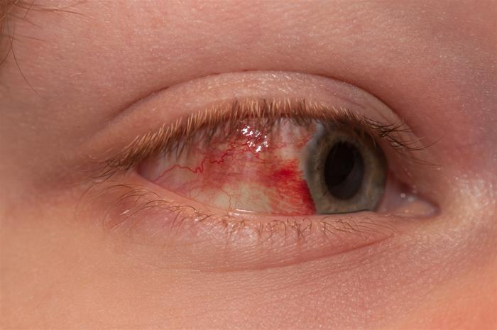 A 34-year-old male presents to the emergency department with a red eye.  He says,  I just woke up this morning and saw that my right eye was red.   He denies any itching, pain or discharge.  He has no known drug or environmental allergies.  He takes no medication.  His vital signs are stable.  The photo of his eye is shown below.   What is the best next step in his management? A) Check intraocular pressure B) Refer to ophthalmologist C) Check coagulation parameters D) Observation E) Antibiotics