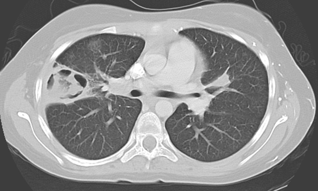 A 54-year-old man comes to the office due to fatigue, a productive cough with blood-tinged sputum, and a 7-kg (15.4-lb)  weight loss over the past few months.  He has no fever, chest pain, or night sweats.  Ten years ago, the patient emigrated from Vietnam, where he received treatment for pulmonary tuberculosis.  He has no other medical history.  He does not use tobacco or illicit drugs but drinks alcohol occasionally.  Temperature is 36.7 C (98 F) , blood pressure is 120/80 mm Hg, and pulse is 82/min.  Lung auscultation reveals right-sided rhonchi and crackles.  Creatinine is 1.1 mg/dL and urinalysis is normal.  CT scan of the chest is shown in the image below.   Which of the following is the most likely diagnosis for this patient? A) Actinomyces israelii infection B) Bacterial lung abscess C) Chronic pulmonary aspergillosis D) Granulomatosis with polyangiitis E) Histoplasmosis F) Small cell lung cancer