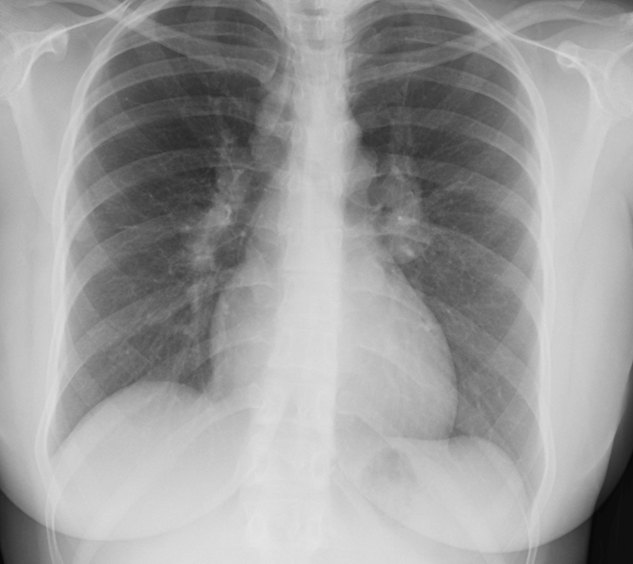 A 38-year-old woman comes to the office due to a dry cough and malaise for the past 2 months.  She has no prior medical issues and takes no medications.  The patient reports no allergies and does not smoke.  Vital signs are normal.  Examination shows no abnormalities.  Her chest x-ray is shown below.   Which of the following is the most likely pathophysiology of this patient's condition? A) Allergen-induced bronchospasm B) Chronic granulomatous inflammation C) Loss of elastin in the lung matrix D) Necrotizing pulmonary vasculitis E) Pulmonary venous congestion F) Recurrent pulmonary embolism