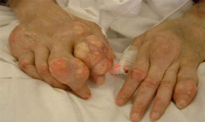 A 68-year-old woman is brought to the clinic by her daughter due to severe pain in her fingers.  Her daughter says,  Mom has had horrible problems with her joints for a long time, but she has never tried to get help.   The patient adds that her fingers have become more swollen and painful over the last few weeks.  She had similar symptoms in her foot last year.  She was given an unknown pain pill, but it was ineffective.  Medical history is notable for hypertension, hypothyroidism, and early Alzheimer dementia.  Vital signs are normal.  Examination findings of the hands are shown in the image below.   What is the most likely diagnosis in this patient? A) Calcinosis cutis B) Chondrosarcoma C) Gout D) Osteoarthritis E) Psoriatic arthritis F) Rheumatoid nodules
