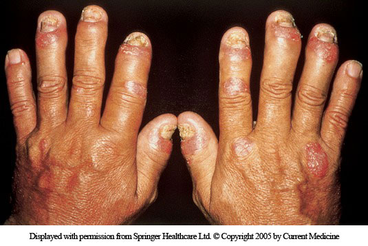 A 52-year-old man comes to the physician with a long history of joint pain.  The patient has pain and stiffness of the small joints of his hands.  The symptoms are worse in the morning and can last several hours.  He also has digit swelling.  The patient's hands are shown in the image below:   Which of the following is the most likely diagnosis? A) Crystalline arthritis B) Dermatomyositis C) Enteropathic arthritis D) Neuropathic arthropathy E) Osteoarthritis F) Psoriatic arthritis G) Rheumatoid arthritis H) Sarcoidosis