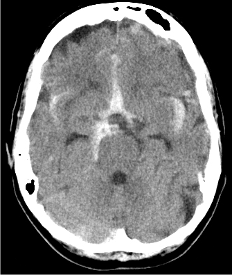 A 40-year-old man comes to the emergency department due to severe headache associated with photophobia and nausea for the past several hours.  The patient reports mild cold symptoms a week ago.  He has a 2-year history of hypertension and has smoked a pack of cigarettes daily for 15 years.  His father died of stroke at the age of 75.  Temperature is 37.7 C (100 F) , blood pressure is 170/100 mm Hg, and pulse is 92/min and regular.  He appears to be uncomfortable and had an episode of nonbilious vomiting in the emergency department.  Neurologic examination shows 4/5 motor strength and 2+ deep tendon reflexes bilaterally in the upper and lower extremities.  Sensation to light touch and pinprick is normal.  CT scan of the head without contrast is shown below.   Which of the following is the most likely cause of this patient's headache? A) Amyloid angiopathy B) Aseptic meningitis C) Cerebral arteriovenous malformation D) Cerebral venous thrombosis E) Hypertensive encephalopathy F) Ruptured berry aneurysm G) Vertebral artery dissection