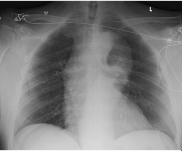 A 59-year-old man comes to the emergency department due to 2 hours of vague chest discomfort.  The discomfort started suddenly while the patient was watching television.  He has no other symptoms.  Blood pressure is reported to be under control with hydrochlorothiazide.  The patient has a 30-pack-year smoking history.  Vital signs are within normal limits.  Physical examination shows clear lungs and normal heart sounds but is otherwise unremarkable.  ECG is normal.  The first set of cardiac enzymes is within normal limits.  Chest x-ray is shown in the image below.   Which of the following is most likely contributing to the pathophysiology of this patient's condition? A) Coronary vasospasm B) Degenerative aortic disease C) Impaired distal esophageal peristalsis D) Longitudinal tear in the esophagus E) Malignant lymphadenopathy F) Sliding hiatal hernia
