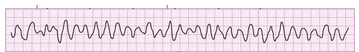 A 72-year-old woman comes to the emergency department due to intermittent chest pain for the last 2 days.  She describes the pain as chest pressure associated with shortness of breath.  She has never had similar symptoms.  Her past medical history is significant for hypertension and hyperlipidemia.  Physical examination reveals no heart murmurs.  ECG shows normal sinus rhythm with T wave inversion in leads V4-V6.  Initial troponin I level is undetectable.  Two hours after the initial evaluation, she becomes unresponsive.  Bilateral arm twitching is noted by the nurse.  Her telemetry strip is shown on the image below.   Which of the following is the best next step in managing this patient? A) Amiodarone B) Defibrillation C) Epinephrine D) Fosphenytoin E) Lidocaine F) Magnesium sulfate G) Synchronized cardioversion