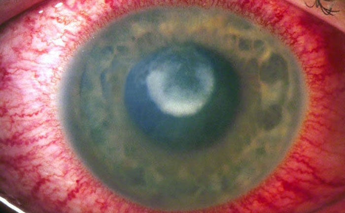 A 32-year-old man complains of right eye pain and discharge.  His symptoms began acutely on awakening in the morning.  He uses extended-wear contact lenses and has had difficulty removing the lenses for the last week.  His past medical history is significant for obesity, chronic back pain, asthma, and acid reflux disease.  On examination, thick, globular yellow discharge is present at the medial eye corner and on the lid margins.  The cornea is edematous, hazy, and ulcerated and there is extensive scleral injection, as shown in the image.  What is the most likely diagnosis in this patient?   A) Angle-closure glaucoma B) Anterior uveitis C) Episcleritis D) Pneumococcal conjunctivitis E) Pseudomonal keratitis F) Subconjunctival hemorrhage G) Viral conjunctivitis
