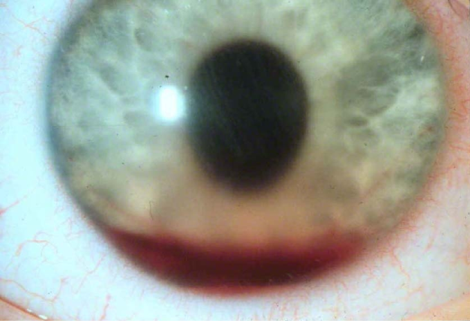 A 19-year-old man is brought to the emergency department due to an eye injury.  About an hour ago, the patient was playing racquetball and was hit in the face by the ball.  He felt pain immediately in his left eye and placed an ice pack over it.  The appearance of the eye on examination is shown in the image below.   This patient's diagnosis increases the risk of which of the following complications? A) Cataract formation B) Corneal neovascularization C) Infectious keratitis D) Intraocular hypertension E) Subconjunctival hemorrhage