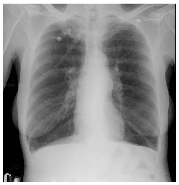 A 68-year-old woman with a history of advanced chronic obstructive pulmonary disease comes to the emergency department due to increased shortness of breath and cough for 12 hours.  She took 2 extra nebulizer treatments at home with no relief of symptoms.  She has no fever, nausea, vomiting, or hemoptysis.  The patient has been oxygen dependent for the last 2 years.  She has a 45-pack-year smoking history and quit about 6 years ago.  Medications include tiotropium daily, fluticasone/salmeterol twice daily, and albuterol by metered-dose inhaler or nebulizer as needed.  Temperature is 36.7 C (98.1 F) , blood pressure is 110/65 mm Hg, pulse is 110/min, and respirations are 28/min.  The patient appears dyspneic and in moderate distress.  She is given intravenous antibiotics, methylprednisolone, and 2 treatments of nebulized ipratropium with albuterol.  Following these measures, the patient remains dyspneic and uses accessory muscles of respiration but is alert and follows commands.  On 4 L/min O<sub>2</sub>, her pulse oximetry is 89%, and arterial blood gas shows pH of 7.30, PCO<sub>2</sub> of 63 mm Hg, and PO<sub>2</sub> of 54 mm Hg.  Chest x-ray, shown in the image below, demonstrates hyperinflation:   Which of the following is the best next step in management of this patient? A) Administer aminophylline B) Decrease supplemental oxygen flow rate C) Increase supplemental oxygen flow rate D) Intubate and mechanically ventilate the patient E) Start noninvasive positive pressure ventilation