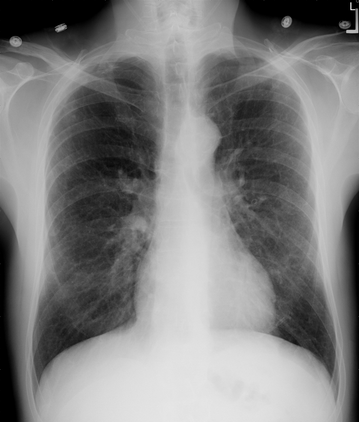 A 68-year-old man comes to the emergency department due to progressively worsening shortness of breath for 2 days.  He has had a week of low-grade fever, runny nose, and productive cough.  The patient's other medical problems include coronary artery disease, hypertension, and hyperlipidemia.  He was hospitalized a year ago for acute myocardial infarction and was treated with drug-eluting stent placement in the left anterior descending artery.  The patient has a 40-pack-year smoking history and quit after the myocardial infarction.  His temperature is 37.2 C (99 F) , blood pressure is 140/90 mm Hg, pulse is 90/min, and respirations are 22/min.  The patient appears to be in mild respiratory distress.  He uses accessory respiratory muscles for breathing but can speak in full sentences.  Neck veins are mildly distended, especially during expiration.  Lung auscultation shows decreased breath sounds and bilateral wheezes.  Heart sounds are distant.  Plasma B-type natriuretic peptide level is 88 pg/mL (normal 0-100 pg/mL) .  Chest x-ray is shown below.   Which of the following is the most likely cause of this patient's presentation? A) Acute asthma exacerbation B) Acute decompensated heart failure C) Acute pulmonary embolism D) Chronic obstructive pulmonary disease exacerbation E) Community-acquired pneumonia F) Subacute cardiac tamponade