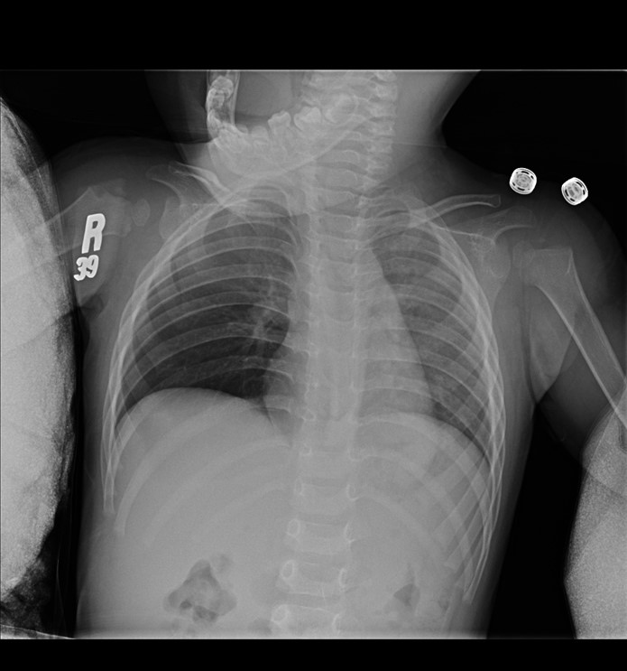 An 18-month-old boy is brought to the emergency department due to respiratory distress.  Severe cough and wheezing began an hour ago while the patient was playing at his cousin's house.  Temperature, blood pressure, and pulse are normal.  Respirations are 46/min, and pulse oximetry is 90% on room air.  Oropharynx is unremarkable.  There are suprasternal and intercostal retractions.  Auscultation reveals a prolonged expiratory phase as well as wheezing without crackles over the right lung.  There is hyperresonance to percussion on the right chest.  The left lung is clear without crackles or wheezes.  Cardiac examination shows normal S1 and S2.  The abdomen is soft and nontender.  Skin examination shows no rashes.  The patient receives a dose of nebulized albuterol and supplemental oxygen with no improvement.  Chest radiograph is shown in the image below:   Which of the following is the most likely cause of this patient's symptoms? A) Anaphylaxis B) Asthma C) Bronchiolitis D) Foreign body aspiration E) Pneumonia F) Pneumothorax