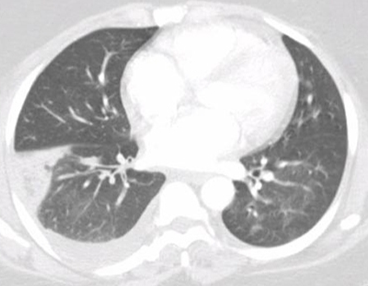 A 34-year-old woman comes to the emergency department after noticing hemoptysis.  Yesterday, the patient developed sudden-onset right-side chest pain and mild dyspnea while getting out of bed.  For the last 4 days, she has had diarrhea as well as nausea and vomiting after eating in a new restaurant.  The patient feels weak and thought her respiratory symptoms were due to being in bed and inactive.  Her chest pain increases with deep breathing.  Her other medical problems include HIV, heroin use, and a prior episode of cellulitis on the right arm.  The patient's last CD4+ cell count 2 months ago was 350/mm<sup>3</sup>, and PPD at that time showed 2 mm of induration.  She has a 15-pack-year smoking history.  Temperature is 38.1 C (100.6 F) , blood pressure is 110/70 mm Hg, and pulse is 112/min.  Mucous membranes are dry.  Breath sounds are diminished at the right lung base.  Chest CT scan is shown below.   Which of the following is the most likely diagnosis? A) Bacterial pneumonia B) Lung cancer C) Pneumocystis pneumonia D) Pulmonary thromboembolism E) Pulmonary tuberculosis