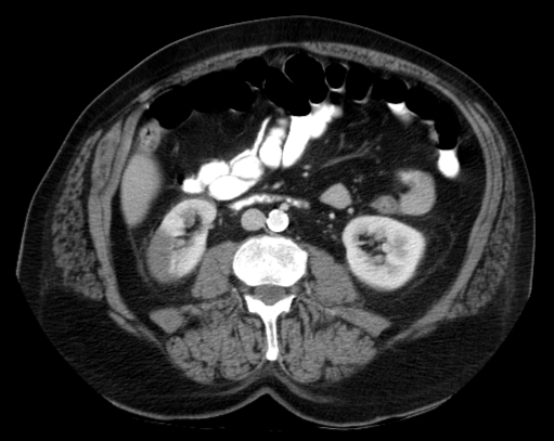 A 45-year-old woman comes to the hospital due to sudden-onset, right-sided flank pain that started 12 hours ago.  The patient has had fever and malaise for the past 2 weeks and has been taking over-the-counter ibuprofen intermittently for a presumed viral infection.  She has had no dyspnea, cough, chest pain, or urinary symptoms.  Temperature is 38.7 C (101.7 F) , blood pressure is 110/78 mm Hg, pulse is 102/min, and respirations are 16/min.  Lung sounds are normal.  A 2/6 systolic murmur is present at the cardiac apex.  Right flank tenderness is present.  The remainder of the examination shows no abnormalities.  Laboratory results are as follows:   CT scan of the abdomen is shown below:   Which of the following is the most likely cause of this patient's current symptoms? A) Acute interstitial nephritis B) Acute pyelonephritis C) Glomerulonephritis D) Nephrolithiasis E) Renal infarction