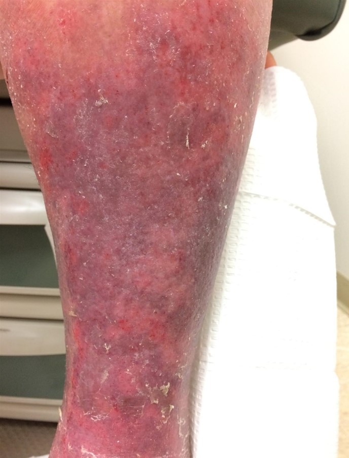 A 58-year-old man, who has not seen a physician in 10 years, comes to the office to establish care.  He reports dry itchy skin over his legs and increased leg discomfort at the end of the day.  He also has had steady weight gain of about 9 kg (20 lb)  over the last 5 years.  The patient has no history of chronic medical conditions and takes no medications.  He has smoked a pack of cigarettes a day for 30 years but is trying to quit because his brother was recently diagnosed with lung cancer.  Blood pressure is 150/84 mm Hg, pulse is 80/min, respirations are 16/min, and pulse oximetry is 98% on room air.  BMI is 34 kg/m<sup>2</sup>.  Neck examination shows no jugular venous distention and a normal thyroid gland.  Cardiopulmonary examination reveals normal heart sounds and mild end-expiratory wheezing.  The lower extremities are warm to the touch below the knees bilaterally and have weakly palpable peripheral pulses.  Intertrigo is present in inguinal creases.  Skin findings are shown in the image below.   Which of the following is most likely to identify the cause of this patient's skin condition? A) Ankle brachial index B) Hemoglobin A1c C) Inguinal lymph node biopsy D) Serum TSH level E) Skin allergy testing F) Skin biopsy G) Venous Doppler ultrasonography