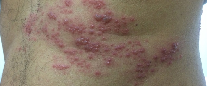 A 46-year-old man comes to the office due to a painful eruption on his left chest and upper abdomen for the past day.  Two days prior to the onset of the rash, the patient experienced a burning pain in the same area that was only partially relieved by acetaminophen and ibuprofen.  He has never had similar symptoms in the past.  Medical history is notable for HIV infection, for which the patient has not yet started antiretroviral therapy.  Temperature is 37.2 C (99 F) , blood pressure is 140/86 mm Hg, and pulse is 94/min.  Skin examination findings are shown below.   Which of the following is the most appropriate initial pharmacotherapy for this patient's skin condition? A) Fluconazole B) Foscarnet C) Gabapentin D) Mupirocin E) Penicillin F) Prednisone G) Valacyclovir