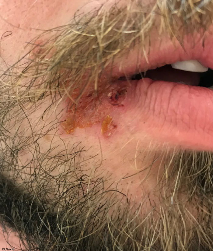 A 22-year-old man comes to the office due to a facial rash.  The patient has a history of cold sores and says he developed a recurrent sore about a week ago after spending hours outside training for a bike race.  He applied a new, over-the-counter lip balm to his lips and the affected area for comfort.  Three days ago, the sore began to crust over as he expected; however, a new, nonvesicular, pruritic rash developed near the site of the sore and has now spread toward the chin.  Examination findings of the rash is shown in the image below:   Which of the following is the most likely cause of this patient's current symptoms? A) Delayed hypersensitivity reaction B) Eczematous inflammation C) Excessive ultraviolet light exposure D) Primary viral infection E) Superficial bacterial infection