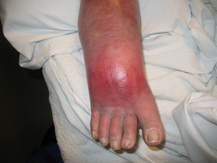 A 62-year-old woman comes to the emergency department due to fever and right foot pain.  She has had increasing redness, warmth, and swelling at the dorsum of the right foot for the last 2 days and woke with pain and subjective fever today.  The patient also has had itching in the skin under and between the toes for the last 6 months.  Medical history is notable for obesity and type 2 diabetes mellitus.  She does not use tobacco or alcohol.  The patient works as a restaurant dishwasher and spends most of the day wearing waterproof rubber shoes.  Temperature is 38.2 C (100.8 F) , blood pressure is 166/98 mm Hg, and pulse is 102/min.  Examination shows erythema and edema at the dorsum of the foot with palpable warmth and an indistinct border.  There is extensive scaling and flaking of the skin between the toes.  Examination findings are shown in the image below:   Palpation of the right inguinal region shows 3 or 4 slightly tender lymph nodes.  Which of the following is the most likely cause of this patient's acute symptoms? A) Allergic reaction to latex rubber B) Deep venous thrombosis of the leg C) Immunologic reaction to dermatophyte antigens D) Infection by gram-positive bacteria E) Obstruction of lymphatic drainage