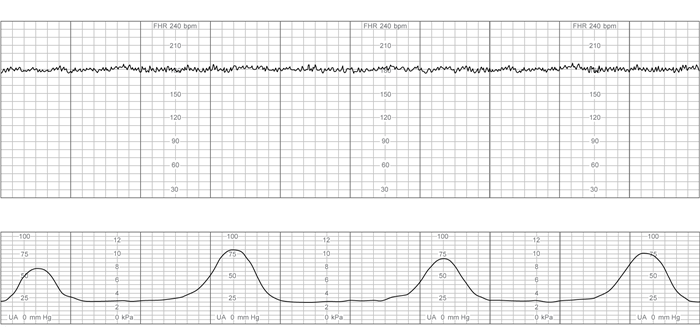 A 36-year-old woman, gravida 1 para 0, at 36 weeks gestation is undergoing induction of labor due to preeclampsia with severe features.  The patient is receiving a magnesium sulfate infusion for seizure prophylaxis and an oxytocin infusion for labor augmentation.  She had spontaneous rupture of membranes with clear fluid 4 hours ago.  The patient had epidural anesthesia placed due to increasingly painful contractions and now has adequate pain relief.  She has a history of hypothyroidism that has been poorly controlled during pregnancy.  Temperature is 39.4 C (103 F) , blood pressure is 150/90 mm Hg, and pulse is 114/min.  Fetal heart rate tracing is shown below:   Which of the following is the most likely cause of this patient's fetal heart rate tracing? A) Congenital hypothyroidism B) Epidural anesthesia C) Magnesium sulfate D) Maternal fever E) Uterine tachysystole
