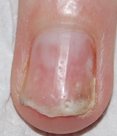 A 47-year-old man comes to the office due to several months of worsening pain, stiffness, and swelling of the bilateral wrists and hand joints.  The symptoms are worse in the morning or after prolonged rest and gradually improve with continued use.  He also has had occasional pain in the ankles and low back, which he attributes to working in the construction industry for many years.  The patient has no significant medical history.  He takes ibuprofen as needed for the pain and over-the-counter emollients for dry skin, but otherwise takes no medications.  He has smoked a pack of cigarettes daily for 20 years and drinks 4 or 5 beers on weekends.  Vital signs are within normal limits.  Physical examination shows swelling and tenderness of the bilateral wrists and hand joints, including the distal interphalangeal joints.  Nail examination findings are shown in the exhibit below.  Which of the following is the most likely cause of this patient's symptoms?   A) Gouty arthritis B) Hypertrophic osteoarthropathy C) Osteoarthritis D) Psoriatic arthritis E) Rheumatoid arthritis