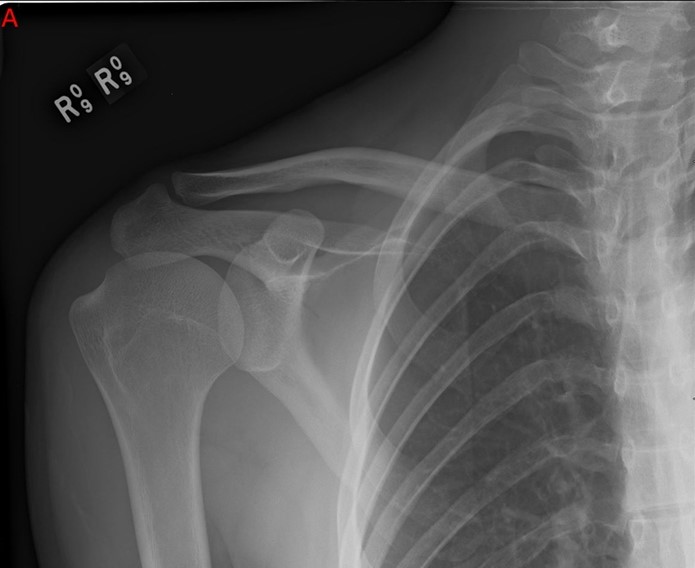 A 55-year-old woman comes to the office with right shoulder pain for the past 2 months.  The patient is unable to raise her arm or reach for objects.  Her right hand is dominant, but she has recently been using her left more due to the problems on the right.  The patient lives with her disabled spouse, who had a stroke 8 months ago.  Before the pain, she had taken care of his daily activities and helped transfer him from his bed to wheelchair but is now unable to do so.  The patient's other medical conditions include type 2 diabetes mellitus, Graves disease, hypertension, and hypercholesterolemia.  On examination, there is markedly decreased passive and active abduction, flexion, and rotation at the right shoulder.  Palpation of the shoulder and acromioclavicular joint do not reproduce the pain.  The remainder of the physical examination is unremarkable.  X-ray of the shoulder is shown below.   Which of the following is the most likely cause of this patient's current symptoms? A) Adhesive capsulitis B) Calcific tendinopathy C) Osteoarthritis D) Rotator cuff tear E) Rotator cuff tendonitis