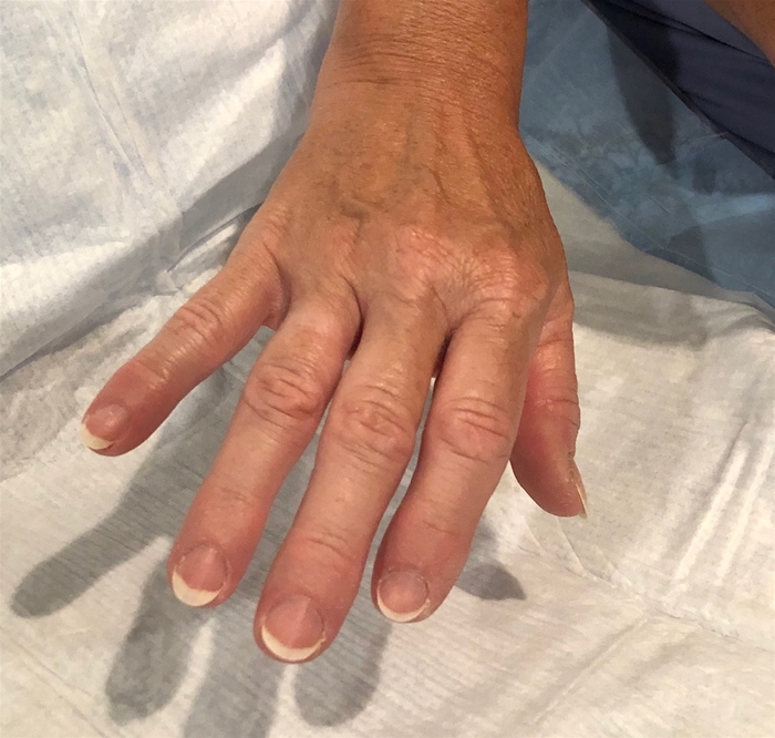 A 51-year-old woman comes to the office due to pain in her hands.  For the past 2 years, she has had daily pain and stiffness in the fingers that are worse when working with hand tools or opening food jars.  The patient has tried massaging her hands and doing stretching exercises, with only partial relief.  Medical history is unremarkable, and she takes no medications.  Vital signs are normal.  Examination reveals mild, hard periarticular enlargement at multiple proximal and distal interphalangeal joints of both hands, as shown in the image below:   Examination of the metacarpophalangeal joints and wrists is normal.  Which of the following is the most appropriate therapy for management of this patient's symptoms? A) Glucosamine B) Methotrexate C) Prednisone D) Topical diclofenac E) Tramadol