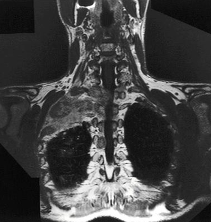 A 64-year-old man comes to the office due to 2 months of weight loss, dry cough, and progressive pain in his right arm.  He was treated for community-acquired pneumonia a year ago.  The patient has a history of type 2 diabetes mellitus and hypertension.  He used to travel internationally for work but retired several years ago.  The patient has a 30-pack-year smoking history but quit 5 years ago.  He drinks alcohol occasionally.  Vital signs are normal.  Physical examination is unremarkable.  Imaging of the chest is shown below.   Which of the following is most likely responsible for this patient's symptoms? A) Aspergilloma B) Bronchial carcinoid C) Cryptogenic organizing pneumonia D) Mesothelioma E) Superior pulmonary sulcus tumor F) Tuberculosis