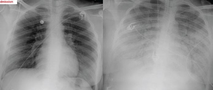 A 27-year-old woman is admitted to the hospital urgently for labor.  The patient has had no prenatal care.  Delivery is complicated by premature rupture of membranes and prolonged labor.  On day 3 of hospitalization, she develops fever, chills, lower abdominal pain, and hypotension.  Postpartum endometritis is suspected.  The patient is prescribed broad-spectrum antibiotics and intravenous fluids.  Over the next 24 hours, she develops increasing shortness of breath.  The patient receives a total of 5 L of normal saline to treat the hypotension.  Temperature is 38.5 C (101.3 F) , blood pressure is 110/66 mm Hg, pulse is 110/min, and respirations are 24/min.  BMI is 34 kg/m<sup>2</sup>.  Pulse oximetry is 80% on a 100% nonrebreather mask, and the decision is made to intubate.  There is no evidence of jugular venous distension.  Cardiac examination is normal except for tachycardia.  Lung auscultation reveals diffuse bilateral crackles.  Mild bilateral pitting edema is present in the lower extremities.  Chest x-rays 24 hours earlier (left)  and at intubation (right)  are shown in the images below:   After intubation, an arterial blood gas test shows a PaO<sub>2</sub> of 60 mm Hg on 100% oxygen and a PaCO<sub>2</sub> of 34 mm Hg.  Which of the following best explains this patient's respiratory symptoms? A) Acute respiratory distress syndrome B) Diffuse alveolar hemorrhage C) Hospital-acquired pneumonia D) Iatrogenic volume overload E) Postpartum cardiomyopathy F) Pulmonary thromboembolism