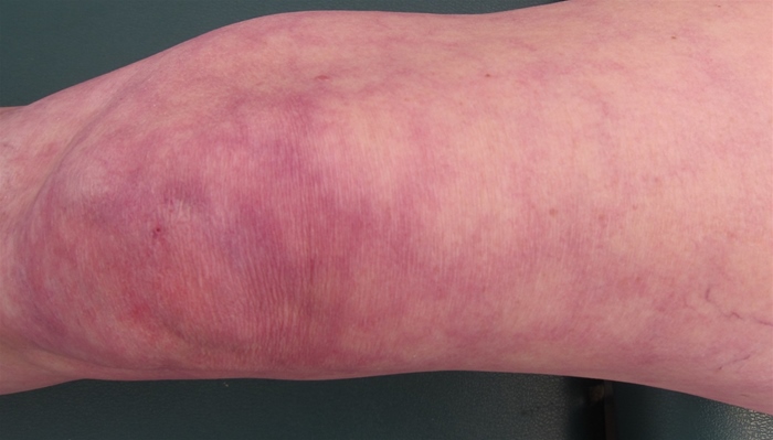 A 68-year-old woman with type 2 diabetes mellitus is hospitalized for an acute ST-segment elevation myocardial infarction.  She undergoes immediate cardiac catheterization and successful stenting of the mid-left anterior descending artery.  The patient is treated with aspirin, prasugrel, metoprolol, lisinopril, and rosuvastatin.  On the third day of hospitalization, she complains of vague abdominal pain.  Her blood pressure is 122/70 mm Hg and pulse is 62/min.  Lungs are clear to auscultation.  There are no cardiac murmurs.  Her abdomen is soft and mildly tender in the periumbilical area.  Bilateral pedal pulses are full and symmetric.  There is bluish discoloration of her right great toe and all the toes on her left foot.  She has additional skin findings as shown below:   Serum creatinine is 2.3 mg/dL (1.1 mg/dL on admission) .  Electrocardiogram (ECG)  shows sinus rhythm and Q waves in anterior leads.  Which of the following is the most likely cause of this patient's symptoms? A) Arterial vasospasm B) Autoimmune vasculitis C) Cholesterol embolism D) Reaction to iodine contrast E) Right-to-left intracardiac shunt F) Side effect of lisinopril