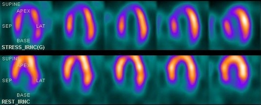 A 47-year-old woman is evaluated for exertional dyspnea.  The patient is a smoker with type 2 diabetes mellitus, mild normocytic anemia, and stage 3 chronic renal disease.  Her family history is insignificant.  Blood pressure is 142/88 mm Hg and pulse is 76/min.  BMI is 32 kg/m<sup>2</sup>.  Single photon emission CT images of the heart are obtained at rest and after 5 minutes of treadmill exercise by using separate intravenous injections of technetium-99-labeled perfusion agent, as seen below, with the bottom panel showing images of the heart at rest (REST) , and the top panel showing images of the heart after exercising (STRESS) .   This patient would benefit most from which of the following medications? A) Albuterol B) Antiplatelet agent C) Appetite suppressant D) Erythropoietin E) Metformin