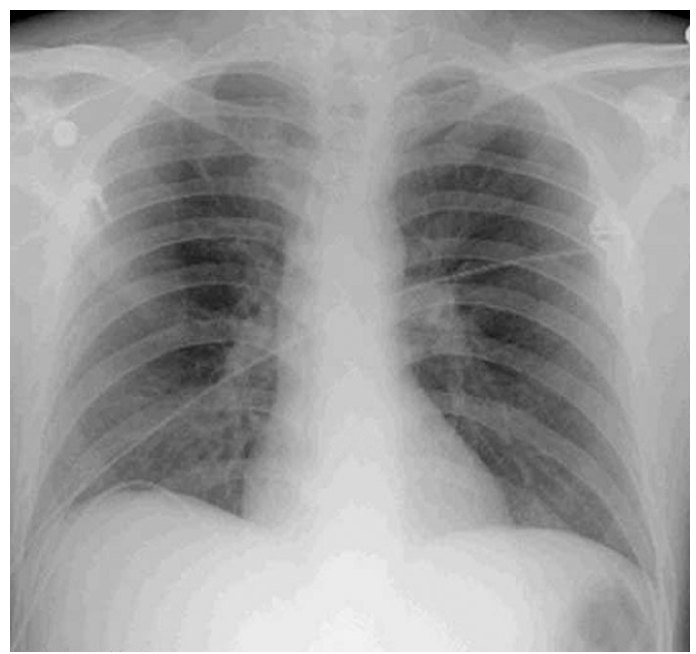 A 46-year-old man comes to the emergency department with chest pain and shortness of breath over the last 10 hours.  The pain is sharp and does not radiate.  He says that taking shallow breaths helps to avoid the pain.  He considers himself healthy and has never had symptoms like this before.  The patient takes over-the-counter antacids for frequent heartburn.  He has a 25-pack-year smoking history, but does not use alcohol or illicit drugs.  His father died at age 47 from a heart attack.  He works as a long-haul truck driver.  His temperature is 36.7 C (98 F) , blood pressure is 110/70 mm Hg, pulse is 110/min, and respirations are 31/min.  The patient's BMI is 29 kg/m<sup>2</sup>.  Electrocardiogram (ECG)  shows sinus tachycardia.  Chest x-ray is shown:   What is the most likely diagnosis in this patient? A) Acute myocardial infarction B) Ascending aortic dissection C) Peptic ulcer perforation D) Pneumothorax E) Pulmonary embolism