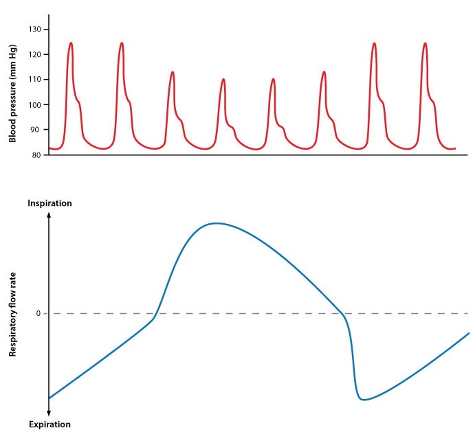 A 34-year-old woman comes to the emergency department with difficulty breathing and dizziness.  An arterial line is placed and her blood pressure tracing is shown below.   Which of the following diagnoses is most consistent with these findings? A) Aortic regurgitation B) Lobar pneumonia C) Mitral stenosis D) Panic attack E) Severe asthma